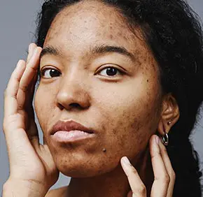 Acne & Blemishes
